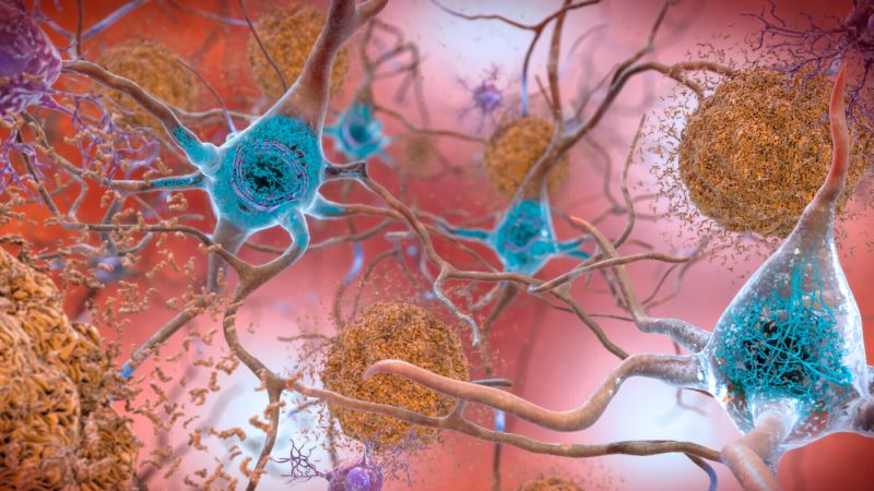Alzheimer's illustration